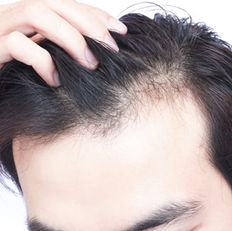 Avaderma Skin & Hair Clinic - Alopecia Areata